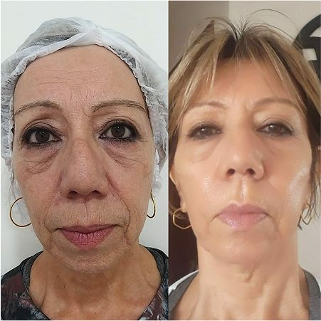 Antes e depois de um tratamento de Bioestimulação de Colágeno e Elastina com técnica exclusiva.